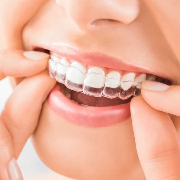 Invisalign Newmarket