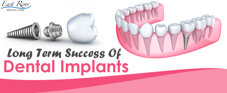 Factors That Contribute To Long - Term Success Of Dental Implants - East River Dental Care - Newmarket - Ontario - Canada