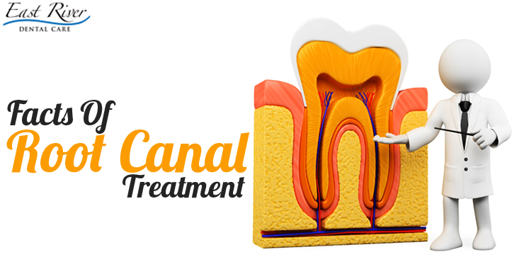 Root Canal Treatment – Know The Facts
