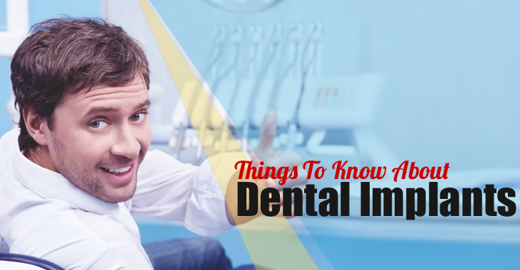 What You Need To Know About Dental Implants?