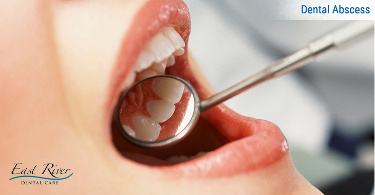 Dental Abscess Causes and How to Cure it!