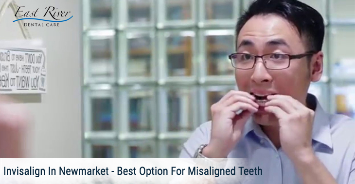 Invisalign In Newmarket – Best Option For Misaligned Teeth