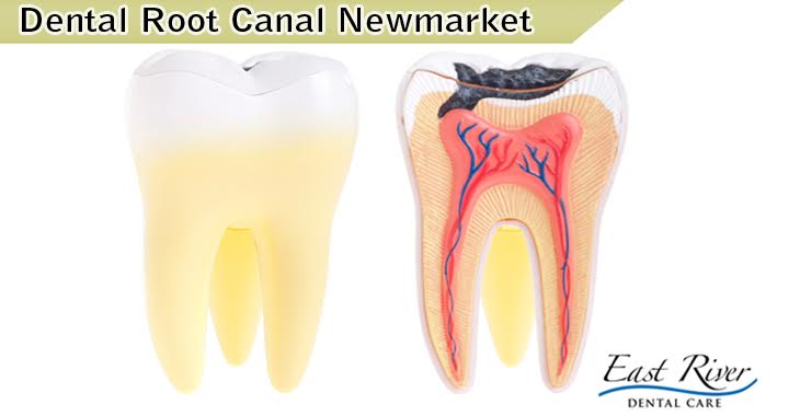 Dental Root Canal Newmarket