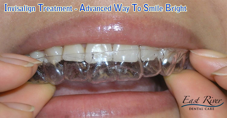Invisalign Treatment – Advanced Way To Smile Bright