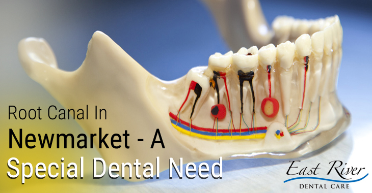 Root Canal In Newmarket – A Special Dental Need