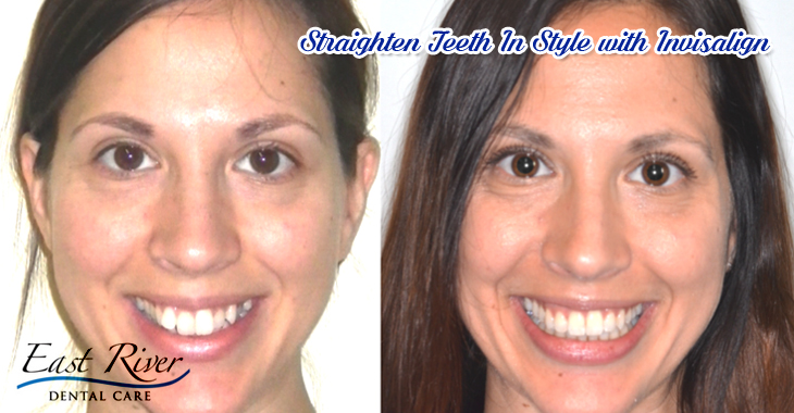 Straighten Teeth In Style with Invisalign
