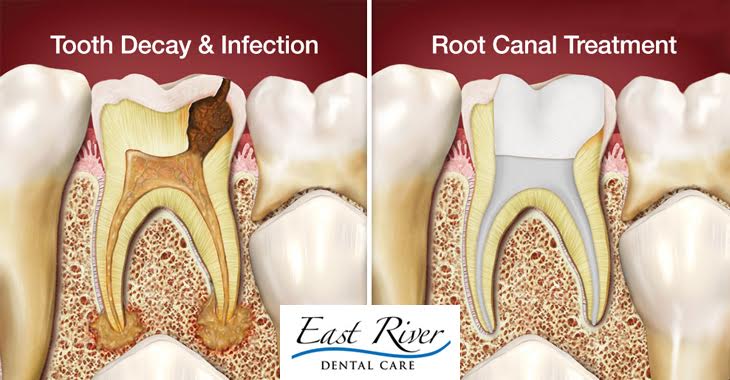 It’s Time You Need Root Canal Treatment