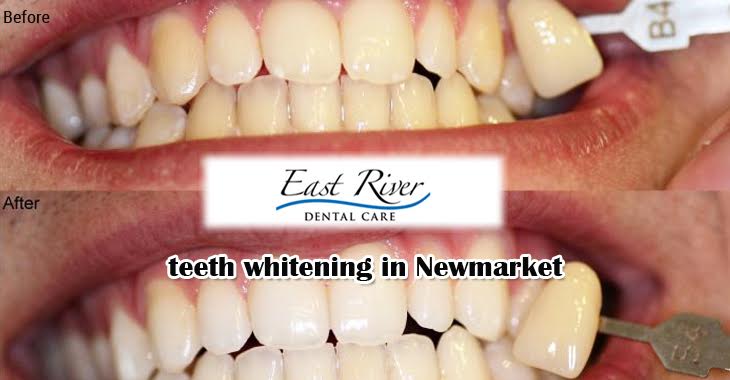 All About Teeth Whitening Procedure by Dentist in Newmarket
