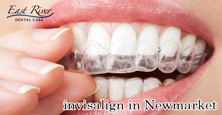 Why Choose Invisalign Over Braces?