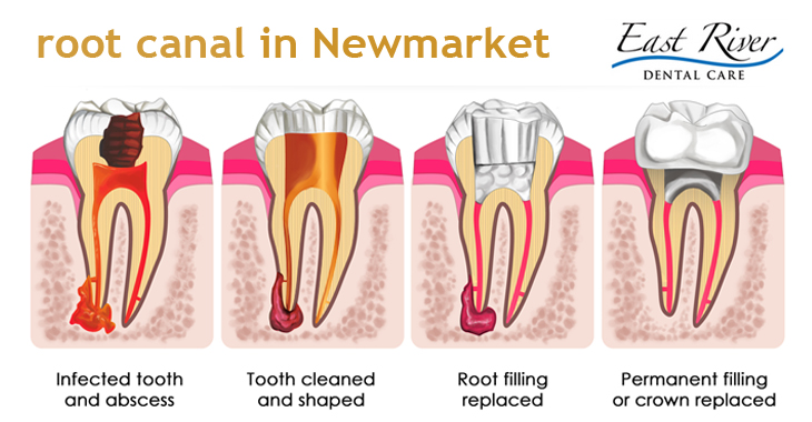 Your Comprehensive Guide On Root Canal by Dentist of Newmarket