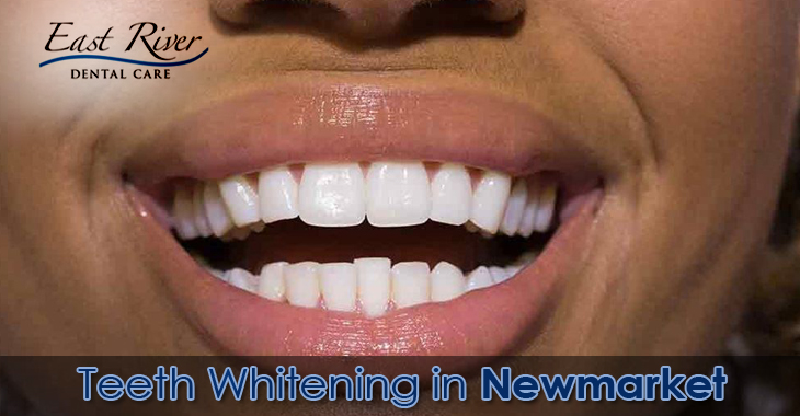 How to Prepare for a Teeth Whitening Procedure?
