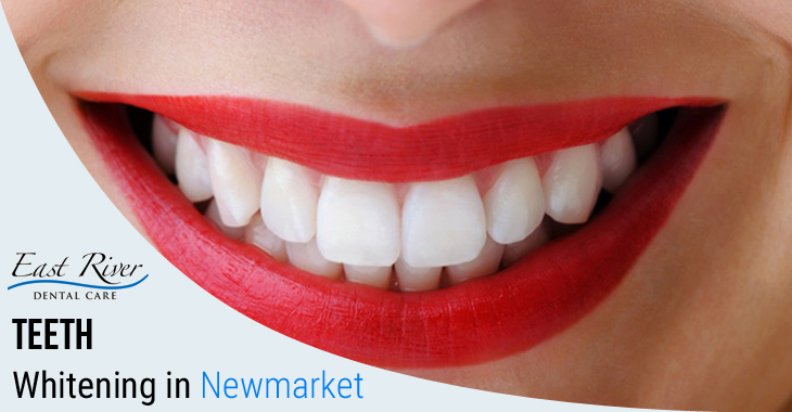 What to Do after leaving a Teeth Whitening Clinic?