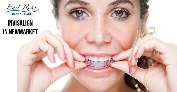 Does Invisalign Require Tooth Extraction Beforehand?