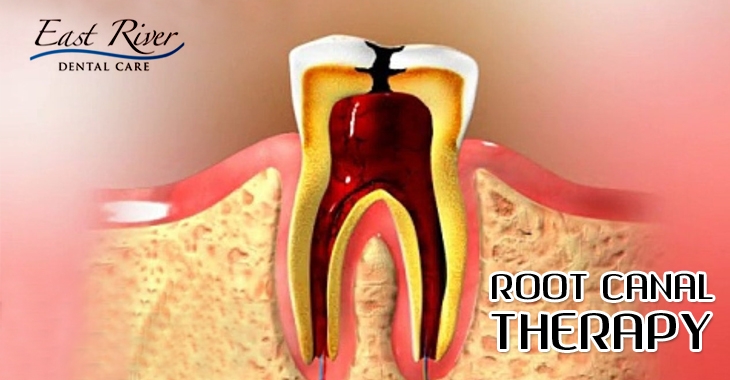 Why Does a Root Canal Still Hurt?
