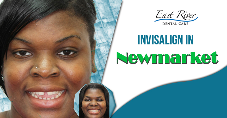 Is Invisalign Safe?
