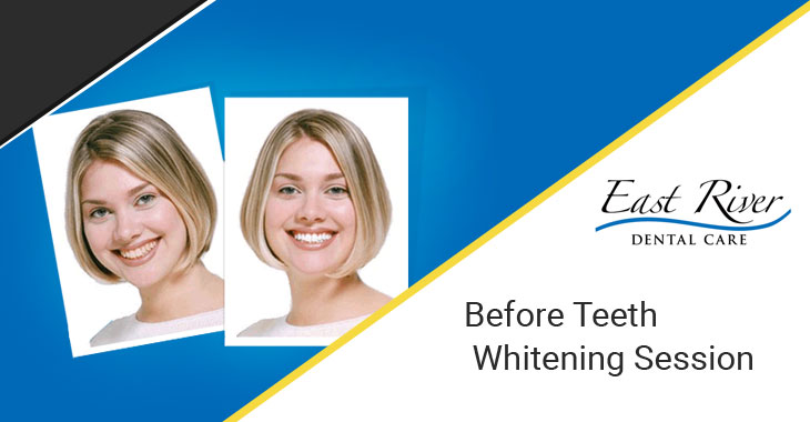 Should You be Worried Before a Teeth Whitening Session?