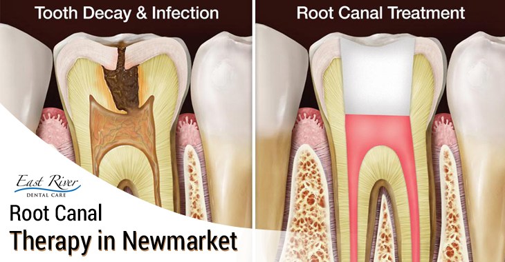 Root Canal Therapy Newmarket