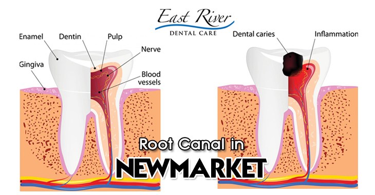 Root canal Newmarket