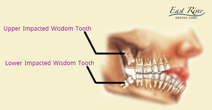 Remove Wisdom Teeth with Dentists in Newmarket