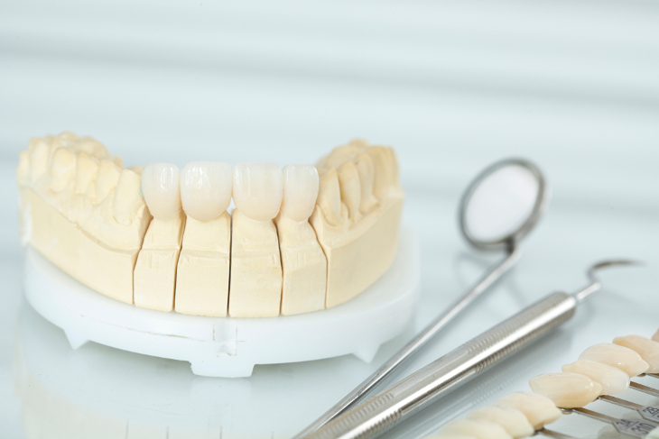 What Are Dental Veneers and How Can They Help Your Smile?