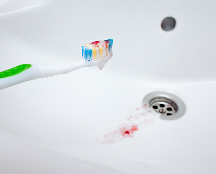 Why Your Gums Bleed When Brushing and What to Do About It